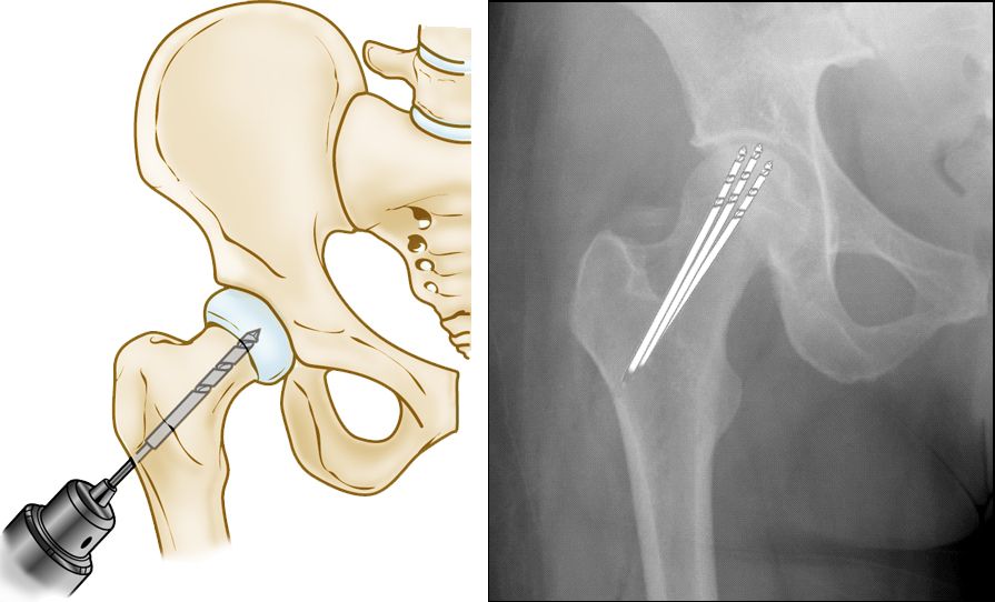 avn treatment in amravati