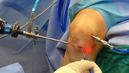 Knee Arthroscopy