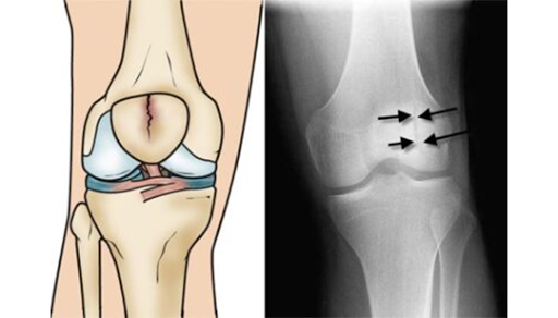 Knee Fracture