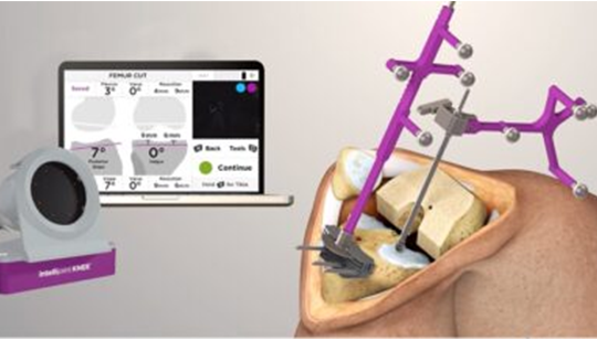 Navigation Based Joint Replacement Surgeries